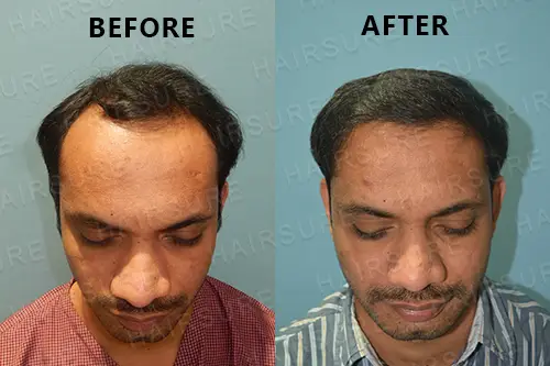 Hairlose-after-before