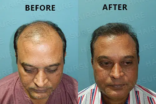 Hairlose-after-before