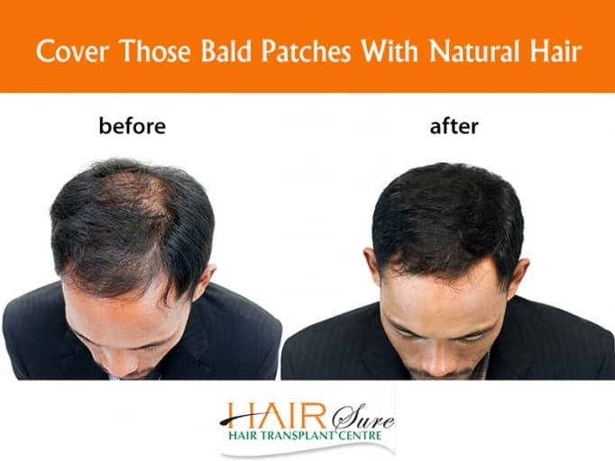 How to Choose Right Surgeon for Hair Transplant Surgery