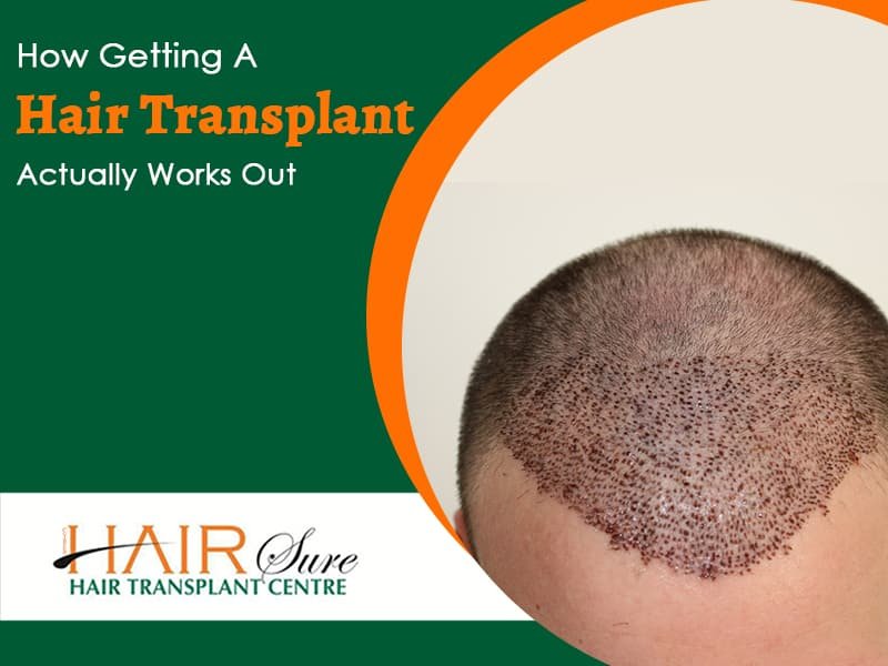 Hair Transplant Surgery And Procedure Cyber Hairsure