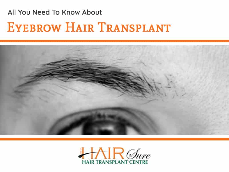 All You Need To Know About Eyebrow Hair Transplant