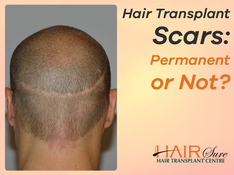 No scars Hair Transplantation methods at Best Hair Transplant, One of the Best Hospitals for Hair Restoration in Hyderabad