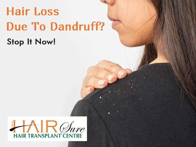Hair Loss Due To Dandruff? Stop It Now!