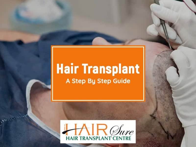 Hair Transplant A Step By Step Guide Cyber Hairsure