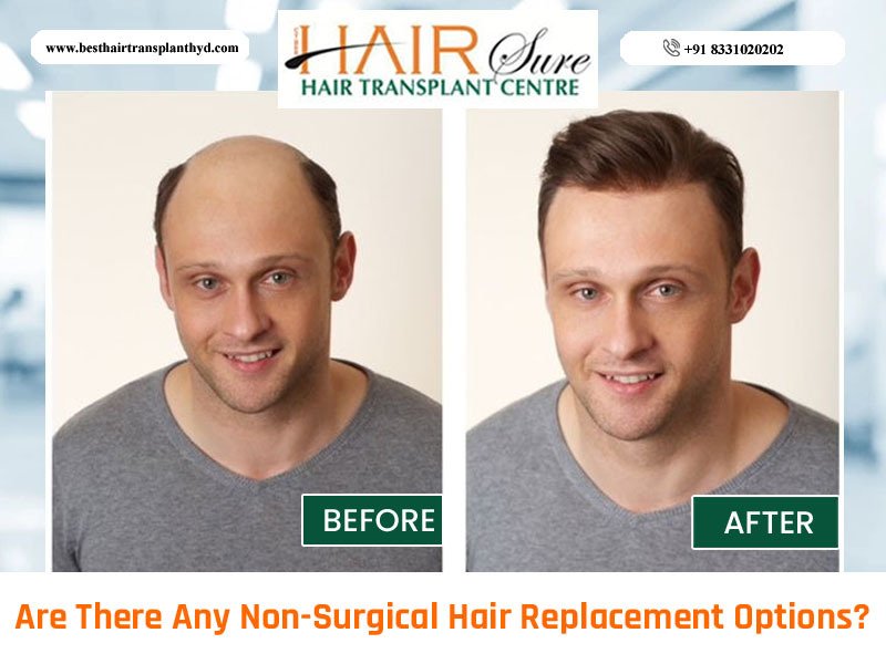 Are There Any Non Surgical Hair Replacement Options