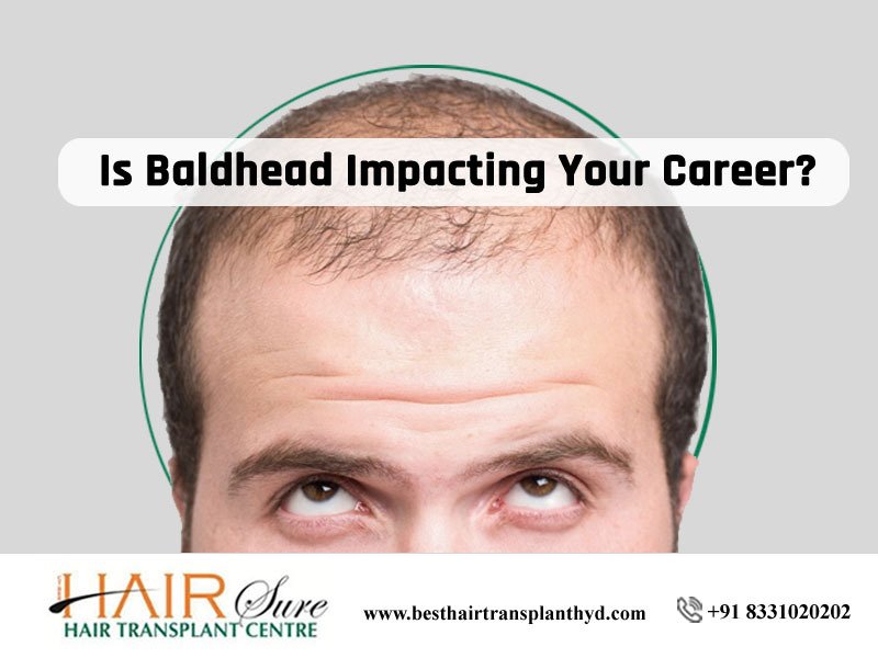 Best ways treat bald head at Best Hair Transplant, hair fall doctor near me Hitech city