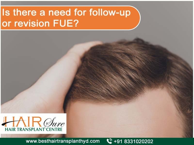 Get the best method for FUE hair transplant in Hyderabad, hair specialist in Hyderabad
