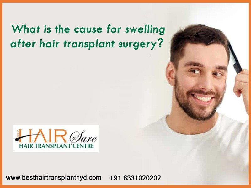 Consult Hair Transplant surgeon Hyderabad for Hair Transplant surgery near me