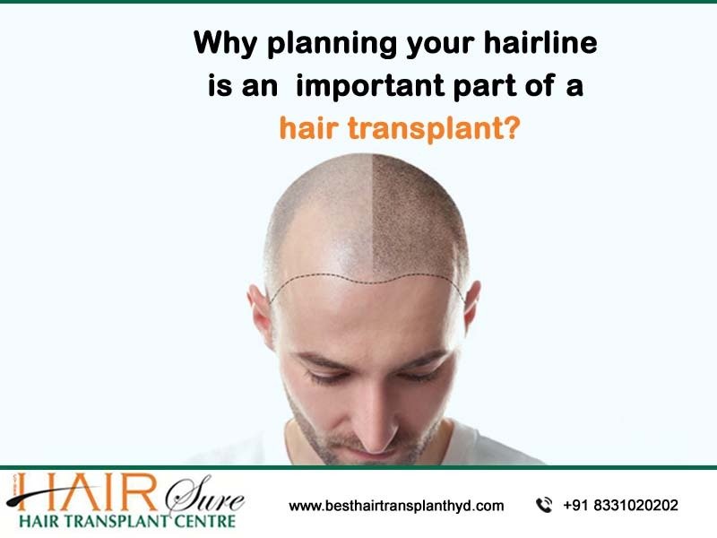 Why Planning Your Hairline Is An Integral Part Of A Hair Transplant