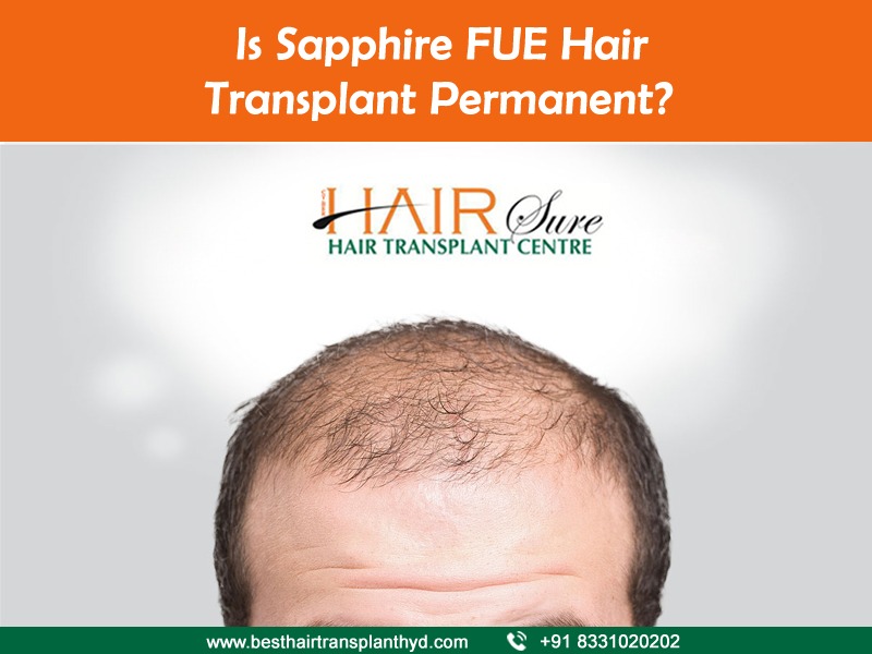 Is Sapphire FUE Hair Transplant Permanent?