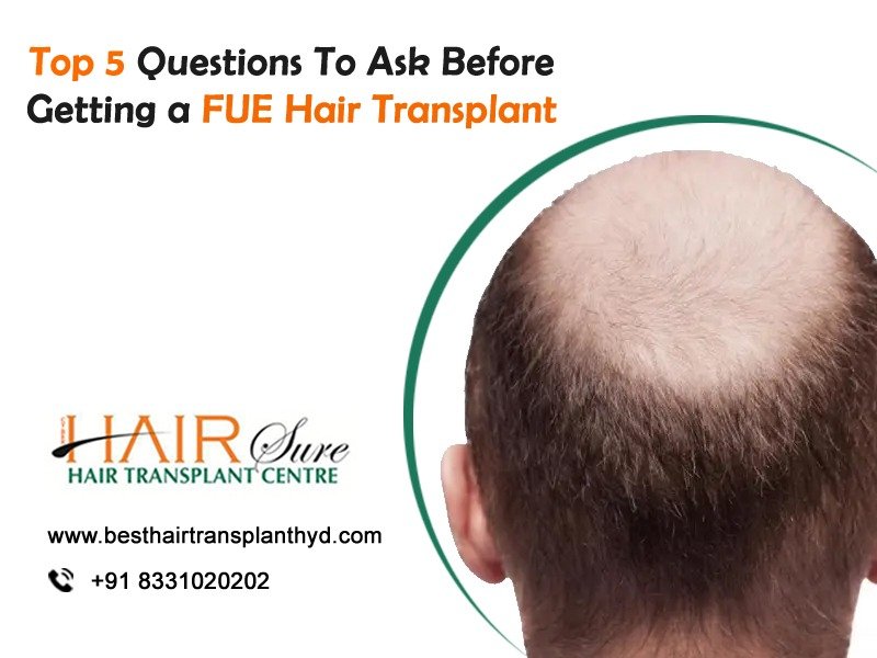 Top 5 Questions To Ask Before Getting An Fue Hair Transplant Cyber