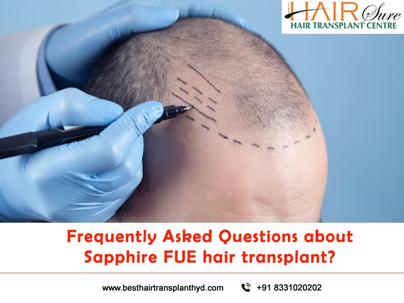 Frequently Asked Questions About Sapphire Fue Hair Transplant
