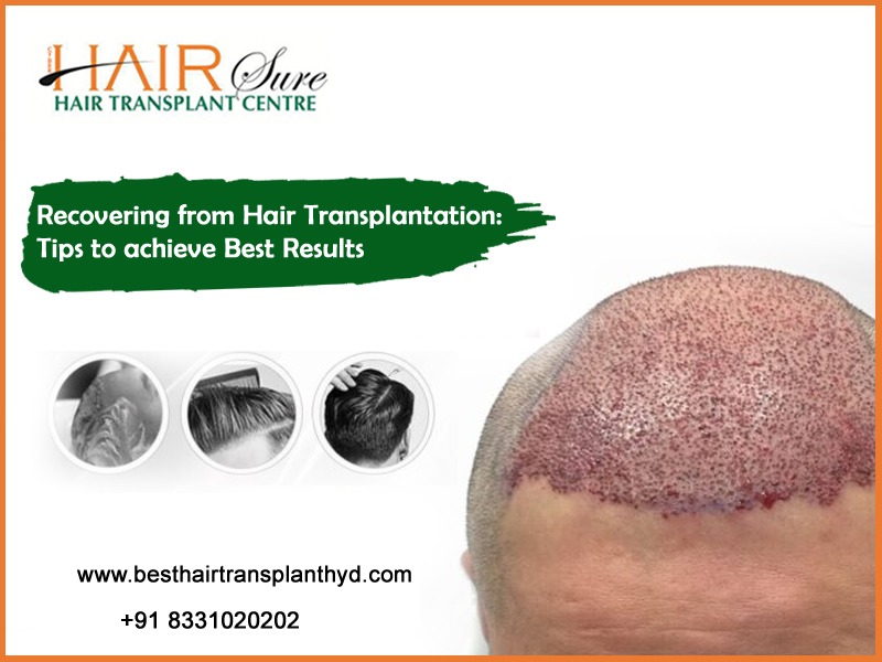Recovering from Hair Transplantation: Tips to achieve Best Results
