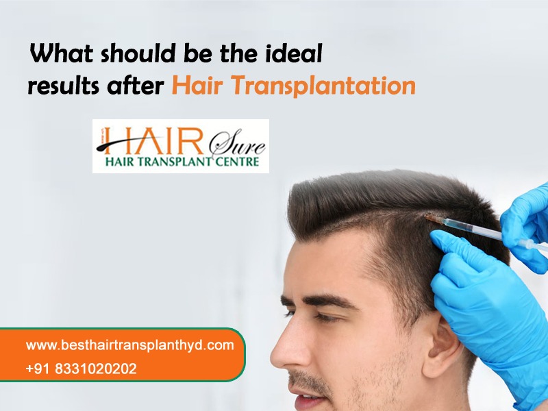 What should be the ideal results after Hair Transplantation?
