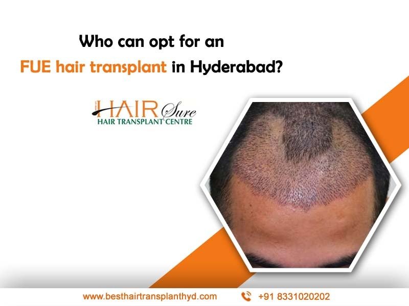 Who Can Opt For An Fue Hair Transplant In Hyderabad Cyber Hairsure 5302