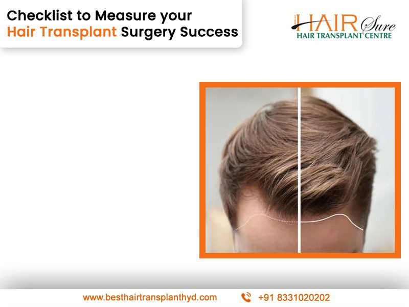 Checklist To Measure Your Hair Transplant Surgery Success Cyber Hairsure