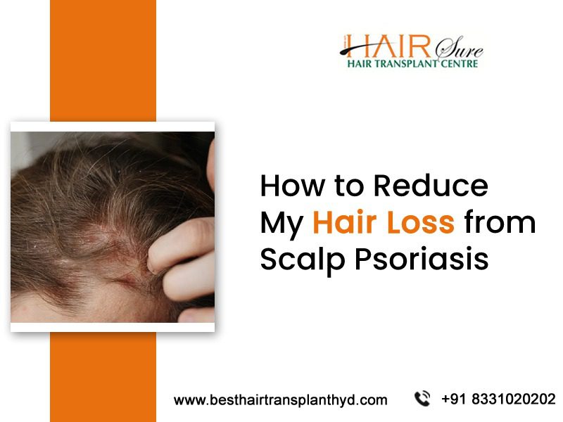 How to Reduce My Hair Loss from Scalp Psoriasis