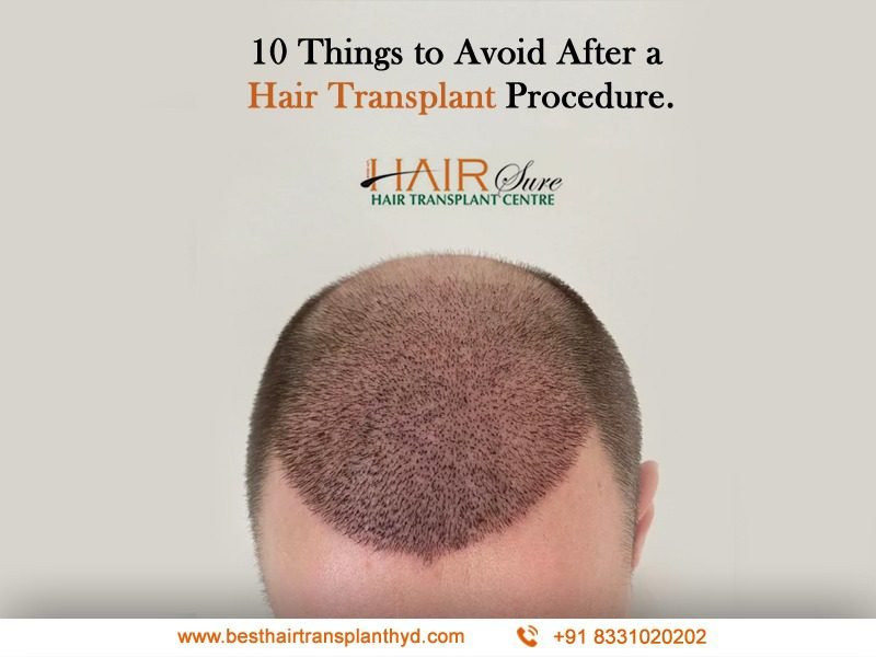 10 Things To Avoid After A Hair Transplant Procedure Cyber Hairsure