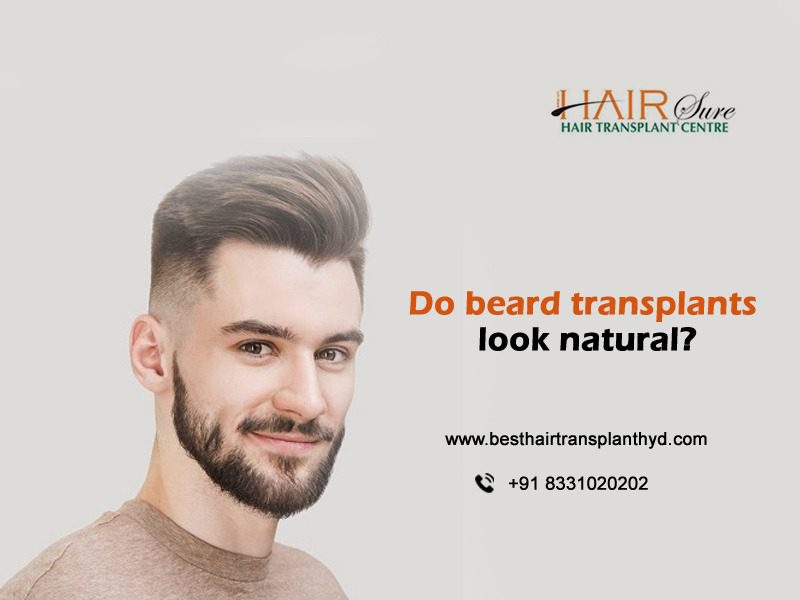 Do beard transplants look natural?
