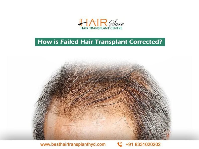 How Is Failed Hair Transplant Corrected Cyber Hairsure