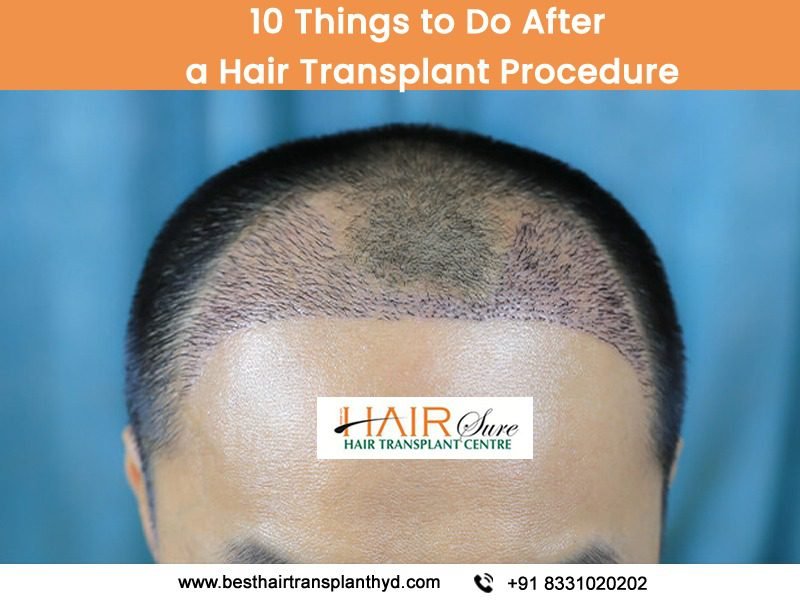 Best Healthy Hair loss treatment by Best hair transplant Surgeon, One of the Best male Hair loss treatment in Madhapur, Hyderabad.