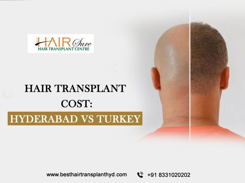 Hair Transplant Cost Hyderabad Vs Turkey