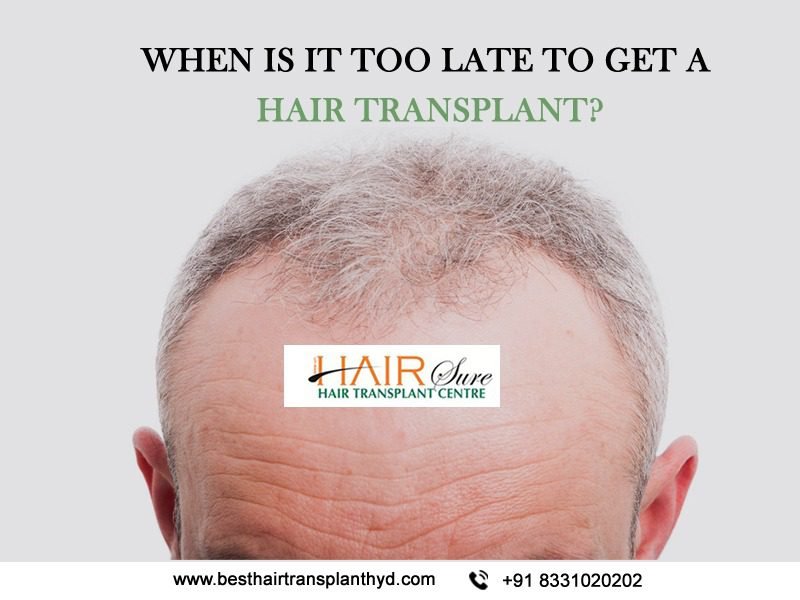 When Is It Too Late To Get A Hair Transplant