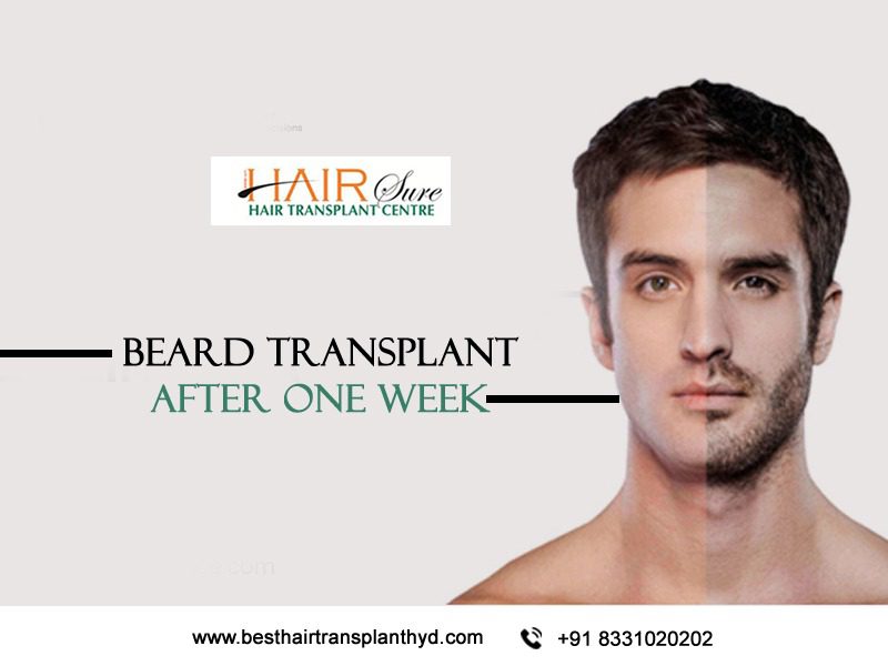 Beard transplant after one week