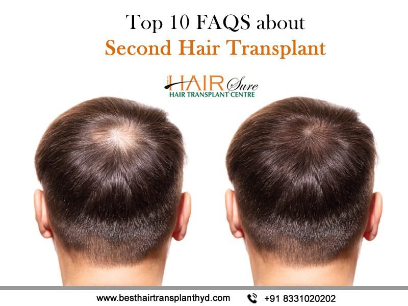 Top 10 Faqs About Second Hair Transplant