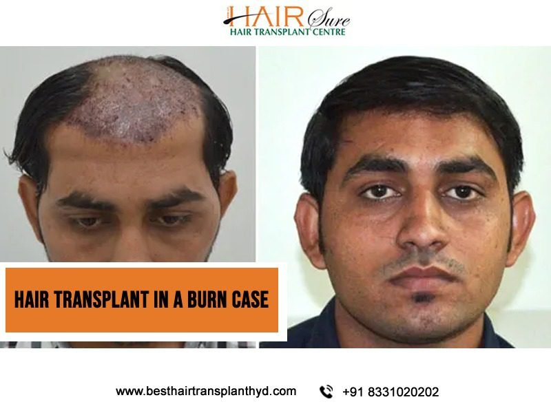 Hair Transplant In A Burn Case
