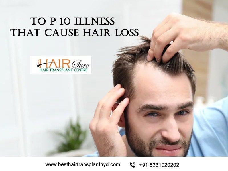 Top 10 Illnesses That Cause Hair Loss