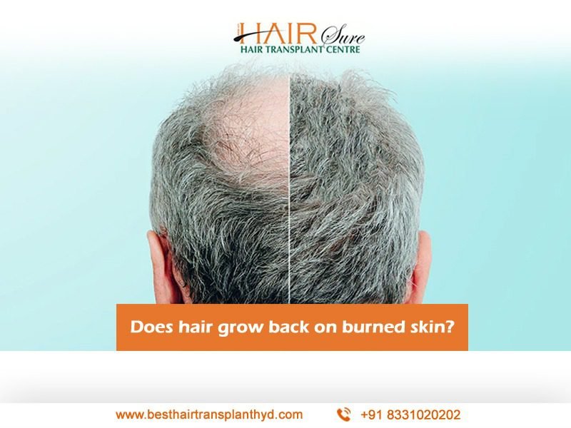 Does Hair Grow Back On Burned Skin
